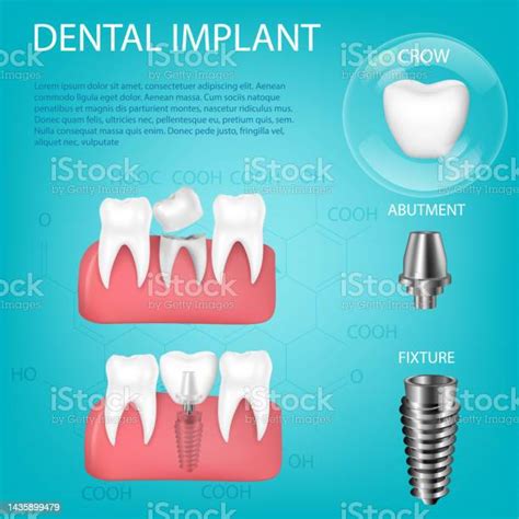 Ilustración De Vector Realista Conjunto 3d De Implantes Dentales Con