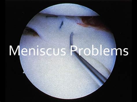 Meniscus Injury Causes Symptoms Treatment Canberra