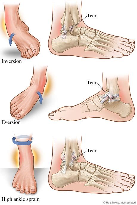 I stepped into one of the holes and i figured it was another sprained ankle. Ankle Pain and Ankle Injury in Augusta GA | Georgia Clinic ...