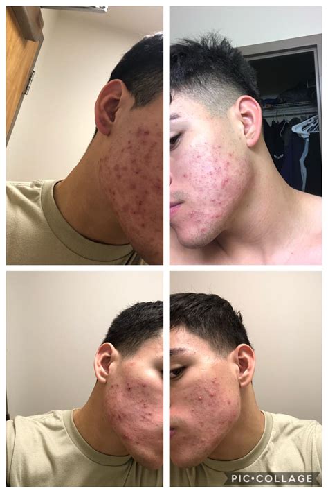Top Two Are Before Starting Accutane And The Bottom Two Are A Month