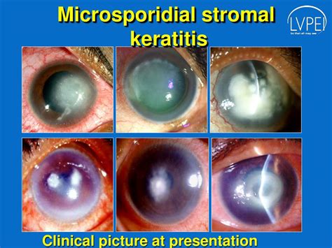 Ppt Microsporidial Stromal Keratitis Dilemma In