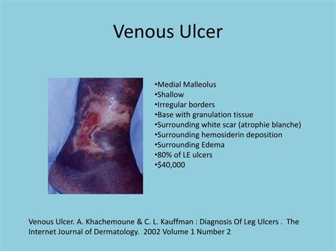 Ppt Venous Insufficiency Powerpoint Presentation Free Download Id
