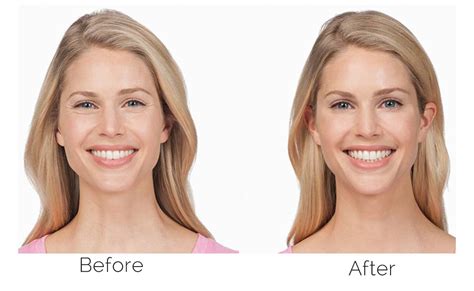 How Botox® Works Skin And Laser Surgery Center Of Pa