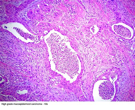 Pathology Outlines Mucoepidermoid Carcinoma