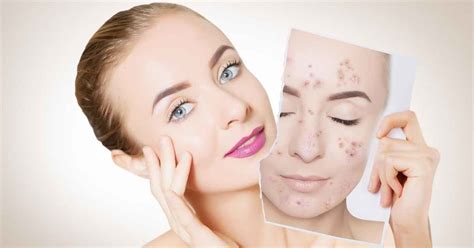 Get Rid Of Acne Permanently Easily Naturally Living Healthy Life