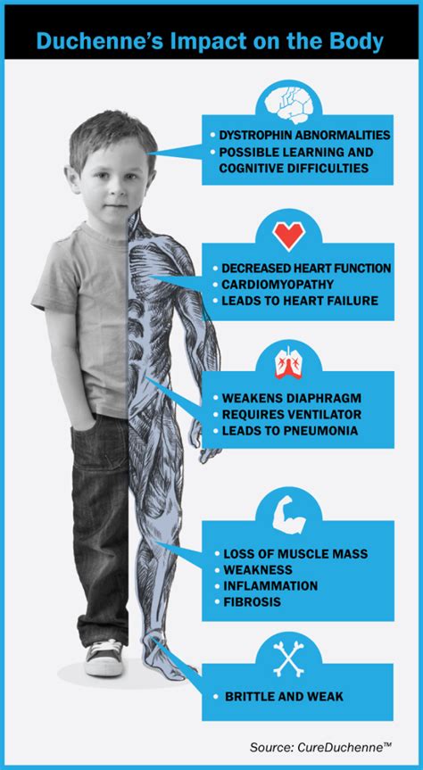 Duchenne muscular dystrophy (dmd) is a rapidly progressive form of muscular dystrophy caused by a mutation in the dmd gene. CureDuchenne - Impact On The Body