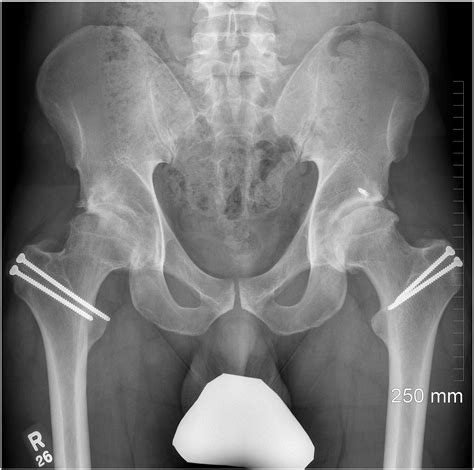 Surgical Dislocation Of The Hip For The Treatment Of Pre Arthritic Hip