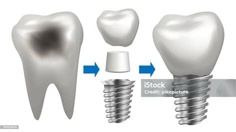 Ilustración De Vector De Implante Dental Diente Con Caries Salud Dental