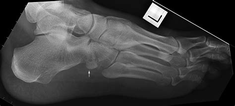 Tarsal Bone Fractures Wikiradiography