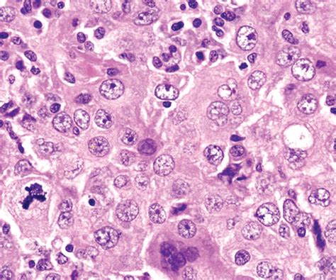 Pleural Mesothelioma Cancer Survival Rate