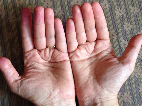 How many babies are born with down syndrome? Zoom Times: The Simian Crease Vs. The Hand of Power