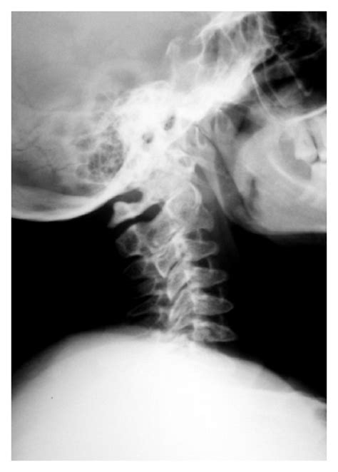 Xr Lateral View Of The Cervical Spine With Wedge Shaped Vertebral