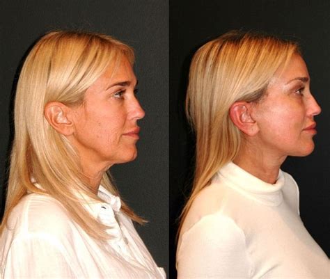 Deep Plane Facelift Technique Before And After Dr Andrew Jacono