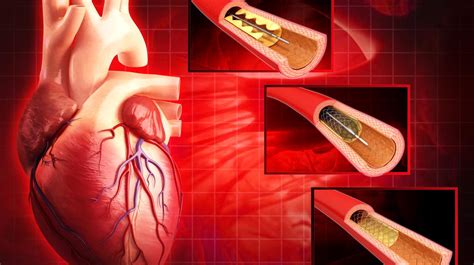 8 Surprising Facts About Cardiac Catheterization