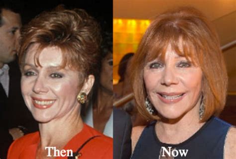 Joy Philbin Plastic Surgery Before And After Photos Latest Plastic