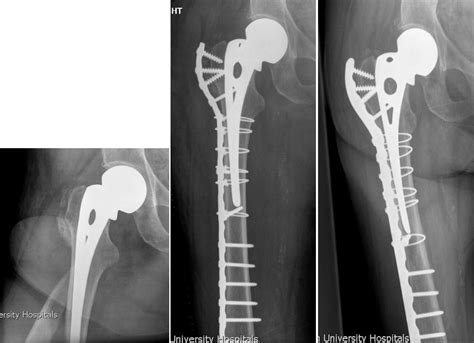 References In Periprosthetic Fractures Around Hip Hemiarthroplasty