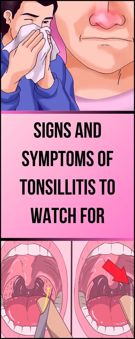 Signs And Symptoms Of Tonsillitis To Watch For Symptoms Of