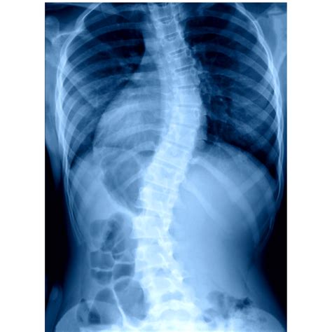 Non Surgical Scoliosis Treatment Wah Toh Tit Tar