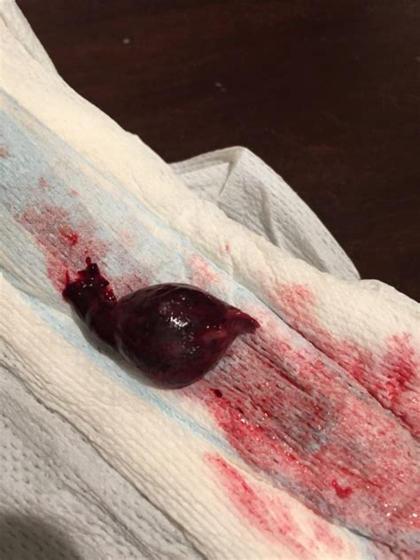 The tiny embryo is completely shredded during the procedure. Warning TMI picture - passed miscarriage? - Glow Community