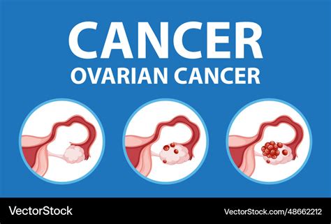 Infographic Of Womans Ovarian Cancer Stages Vector Image