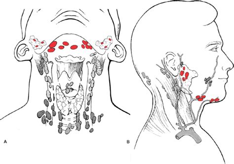 Parotid Cancer Lymph Nodes