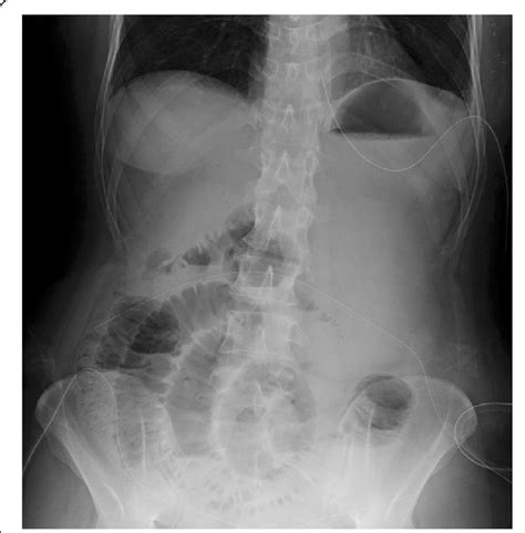 Abdominal X Ray Examination Showing Niveau Sign Download Scientific