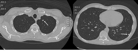 Pdf Pulmonary Cryptococcosis In A Patient With Ulcerative Colitis