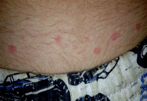 What Do Bed Bugs Bites Look Like Pictures Of Bed Bug Vrogue Co