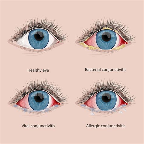 Pink Eye Azar Eye Clinic