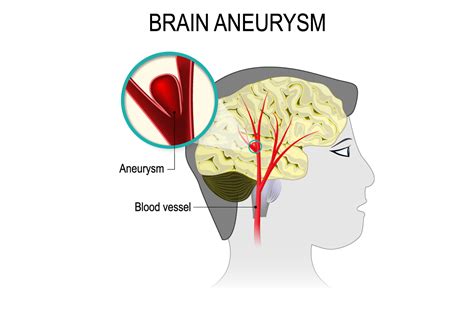 Numbness of one side of the face Aneurysm care | HonorHealth