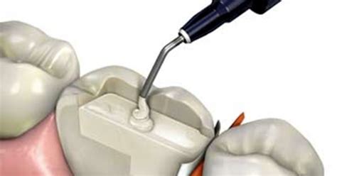 Dental Composites What To Look For And What To Get Spear Education