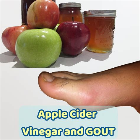 Apple Cider Vinegar For Gout 7 Home Remedies For Gout Natural Home