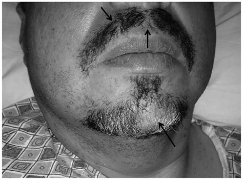 Alopecia Areata As A Paraneoplastic Syndrome Of Hodgkins Lymphoma A
