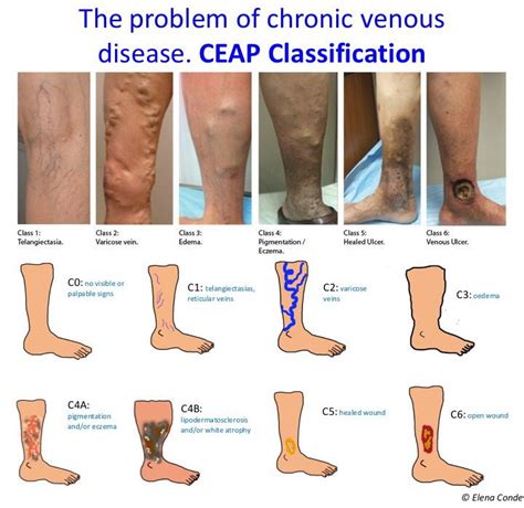 Classification Of Venous Disease My XXX Hot Girl
