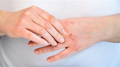 10000印刷√ Eczema Causes 129239 Eczema Causes And Treatment