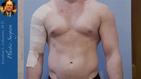 The Definition Of Puffy Nipple Gynecomastia Surgery By Dr Lebowitz