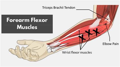 Forearm Flexor Pain