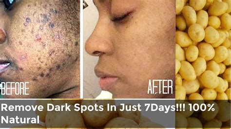 How To Remove Dark Spots Hyperpigmentation In Just 7 Days 100