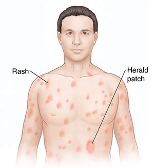 Ninth report of the international committee on taxonomy of viruses. Krames Online - Understanding Pityriasis Rosea