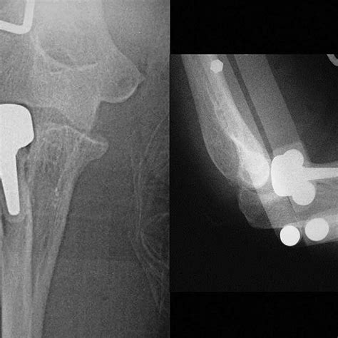 Pdf Anterior Elbow Subluxation After Radial Head Arthroplasty For