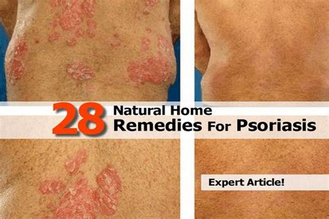 28 Natural Home Remedies For Psoriasis