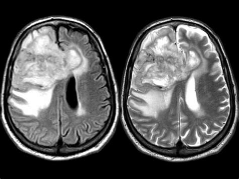 Mri Brain With Contrast Revealed Peripherally Enhanced Space