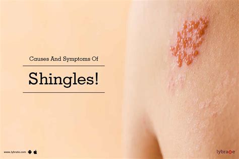Causes And Symptoms Of Shingles By Dr Nitin Jain Lybrate