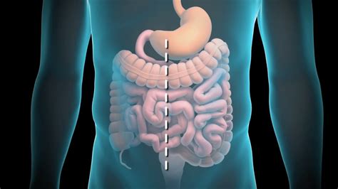 Get the facts on colon cancer (colorectal cancer) symptoms, stages, treatment learn the stages of colon cancer and what to do about polyps. Colon Resection - YouTube