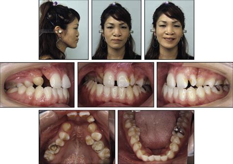 Comprehensive Treatment Approach For Bilateral Cleft Lip And Palate In