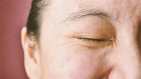 “understanding And Treating Dry Skin Around Eyes