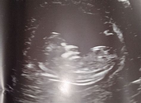 12 Week Ultrasounds Babycenter