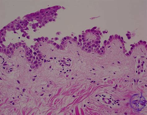 20skin 2 Vesiculobullous Disease Bullous Pemphigoidpathology Core