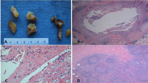 A Gross Photograph Of Cut Surfaces Of Mesenteric Lymph Nodes Central