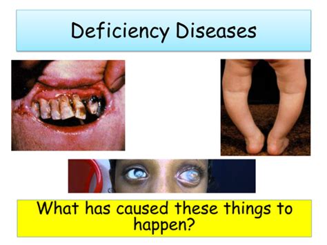 Deficiency Diseases By Nparkie0 Teaching Resources Tes